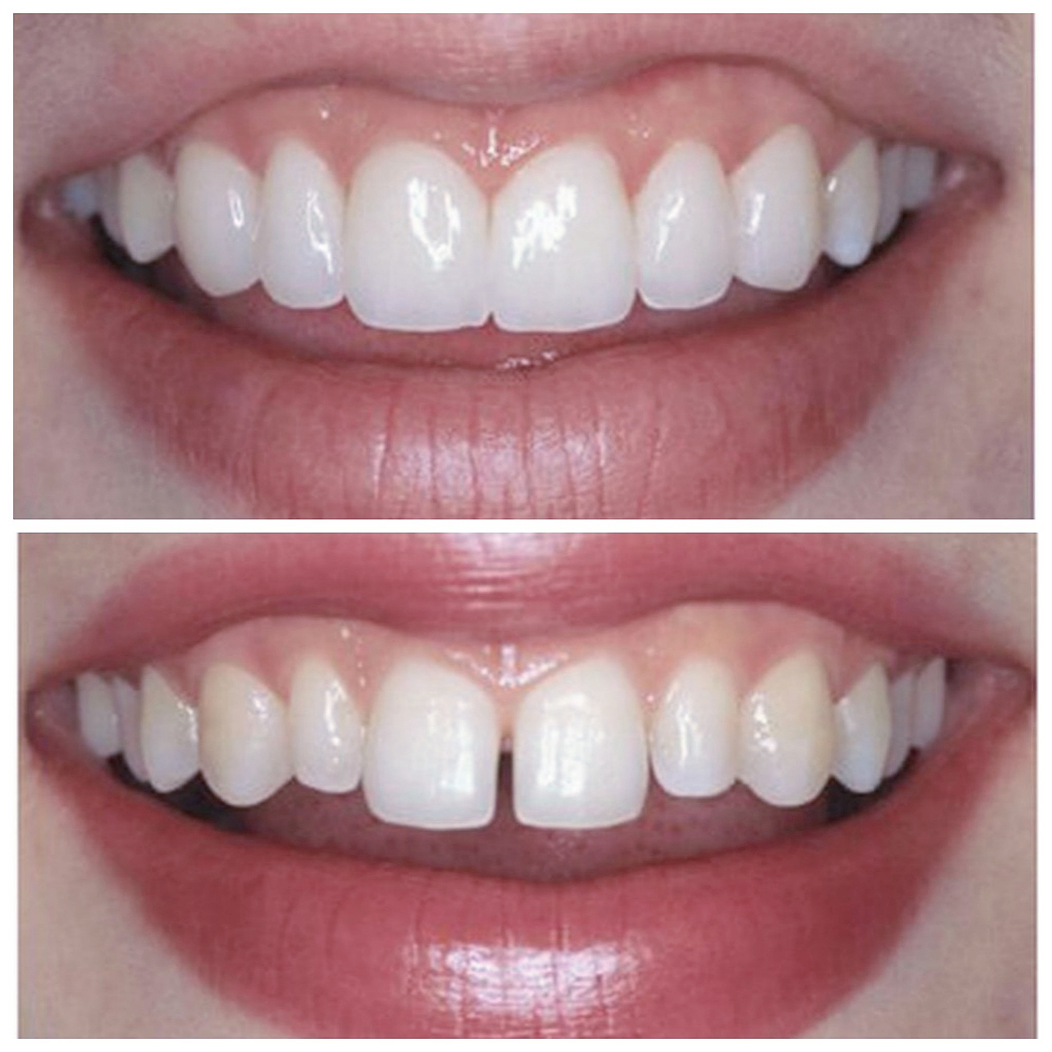 Изменение формы зубов. Композитное наращивание зубов.