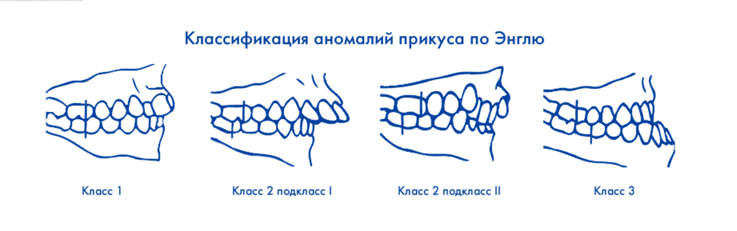 Классы окклюзии. Классификация аномалий Энгля. Аномалии прикуса по Энглю. Классификация аномалий прикуса по Энглю. Скелетная аномалия прикуса.