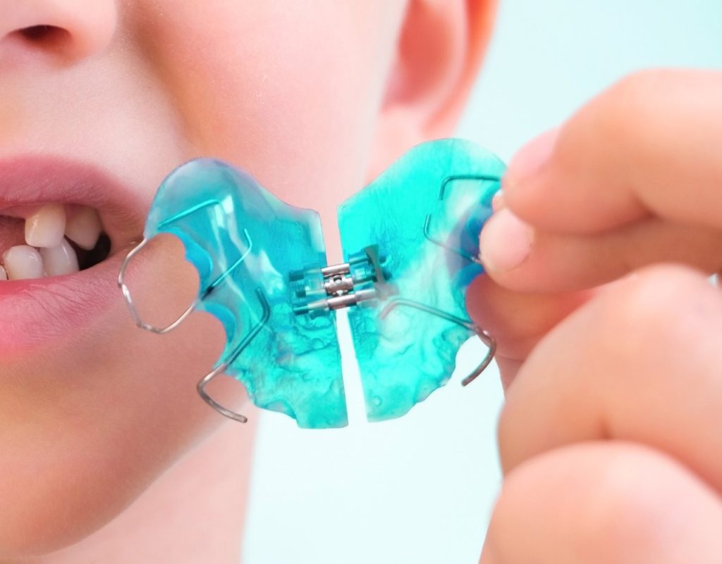 Как подкручивать пластинку для зубов: правильно подтягиваем зубную установку (видео)